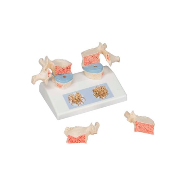 3B Anatomical Model - Osteoporosis Model